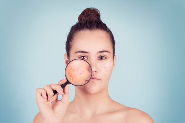 Hormonal acne treatment
